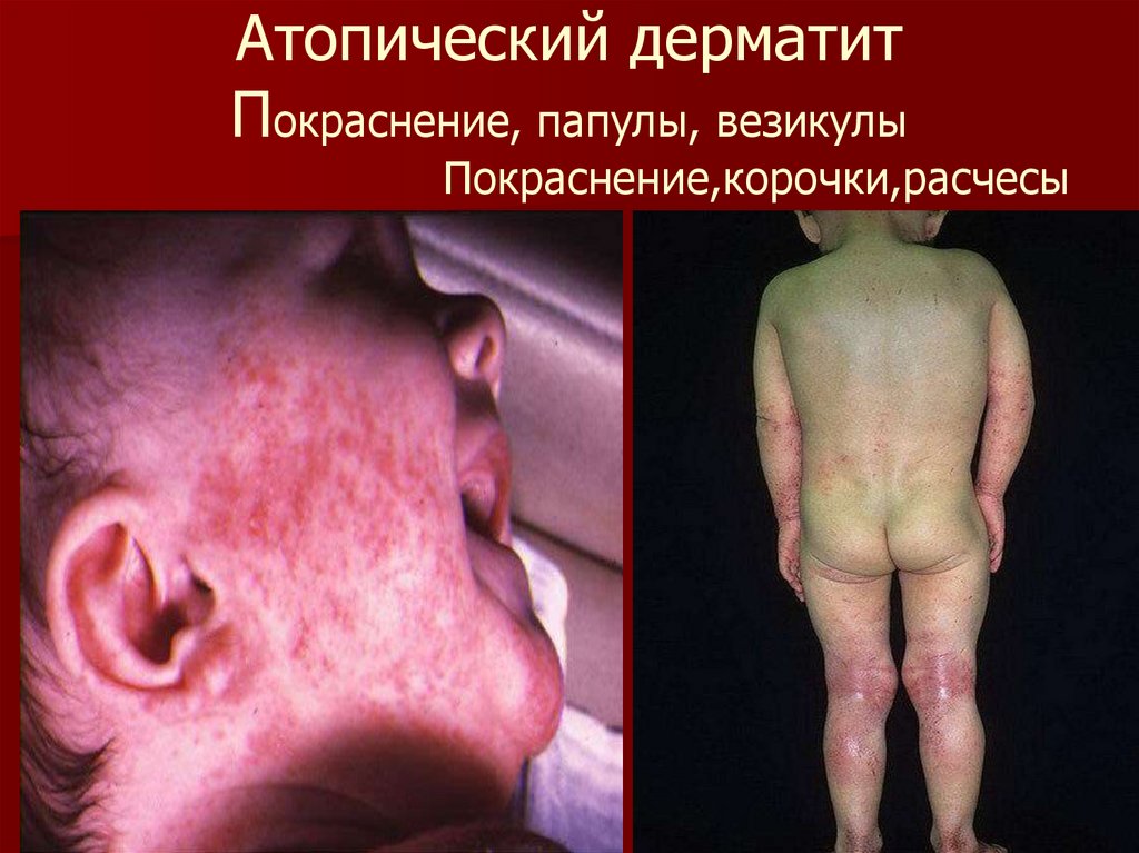 Атопический дерматит Покраснение, папулы, везикулы Покраснение,корочки,расчесы