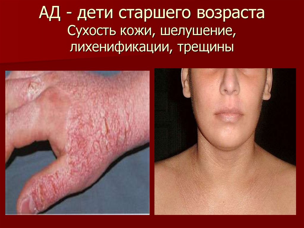 АД - дети старшего возраста Сухость кожи, шелушение, лихенификации, трещины