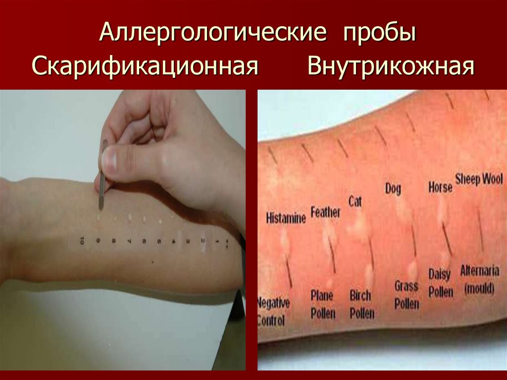 Аллергологические пробы Скарификационная Внутрикожная