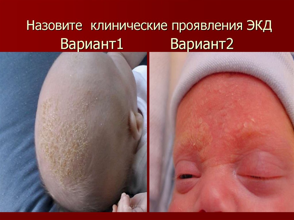 Назовите клинические проявления ЭКД Вариант1 Вариант2