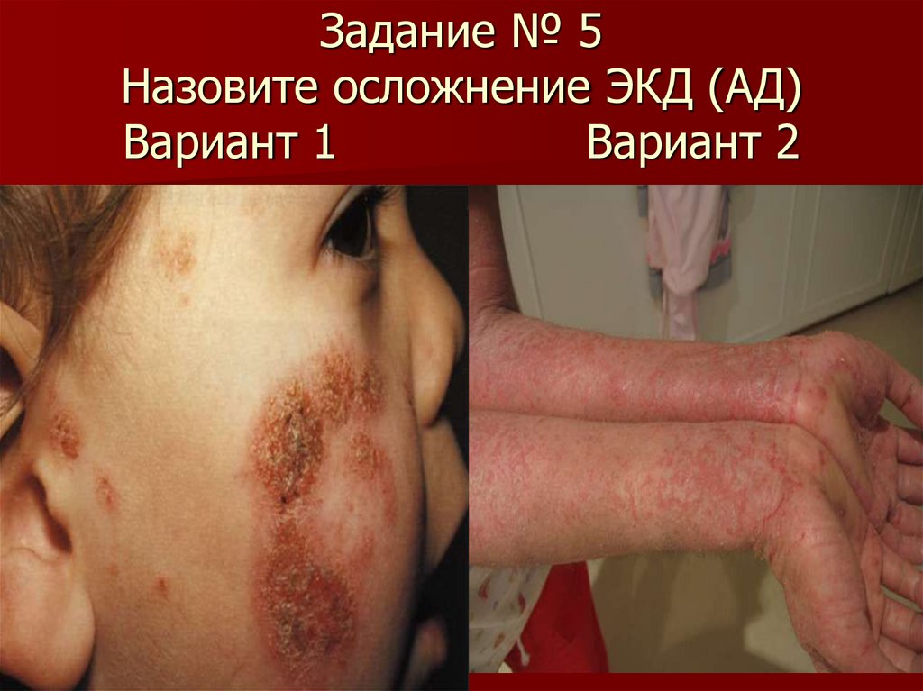 Задание № 5 Назовите осложнение ЭКД (АД) Вариант 1 Вариант 2