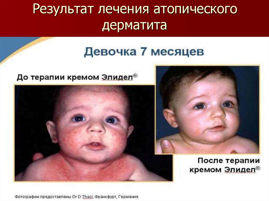 Результат лечения атопического дерматита