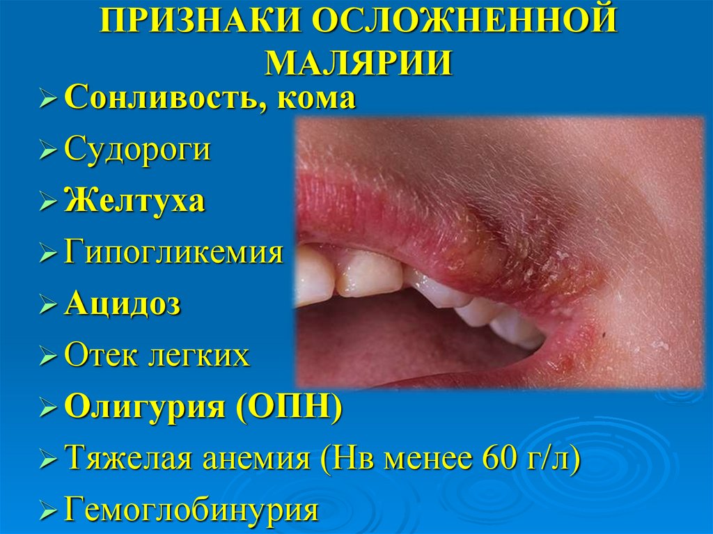 ПРИЗНАКИ ОСЛОЖНЕННОЙ МАЛЯРИИ