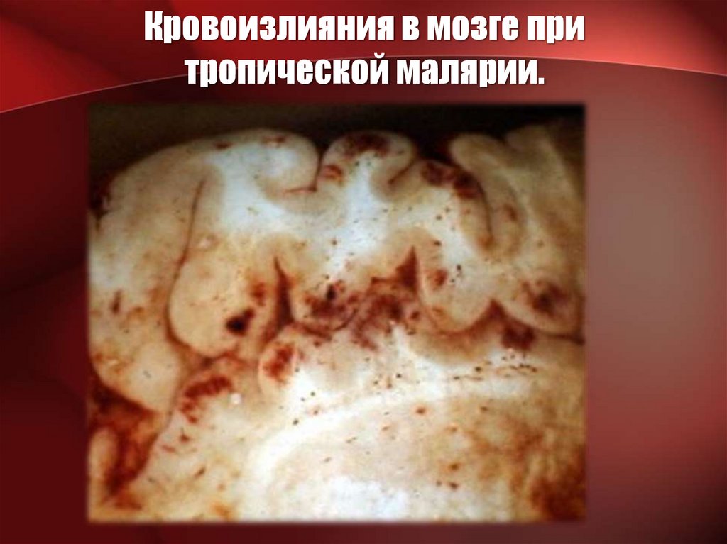Кровоизлияния в мозге при тропической малярии.