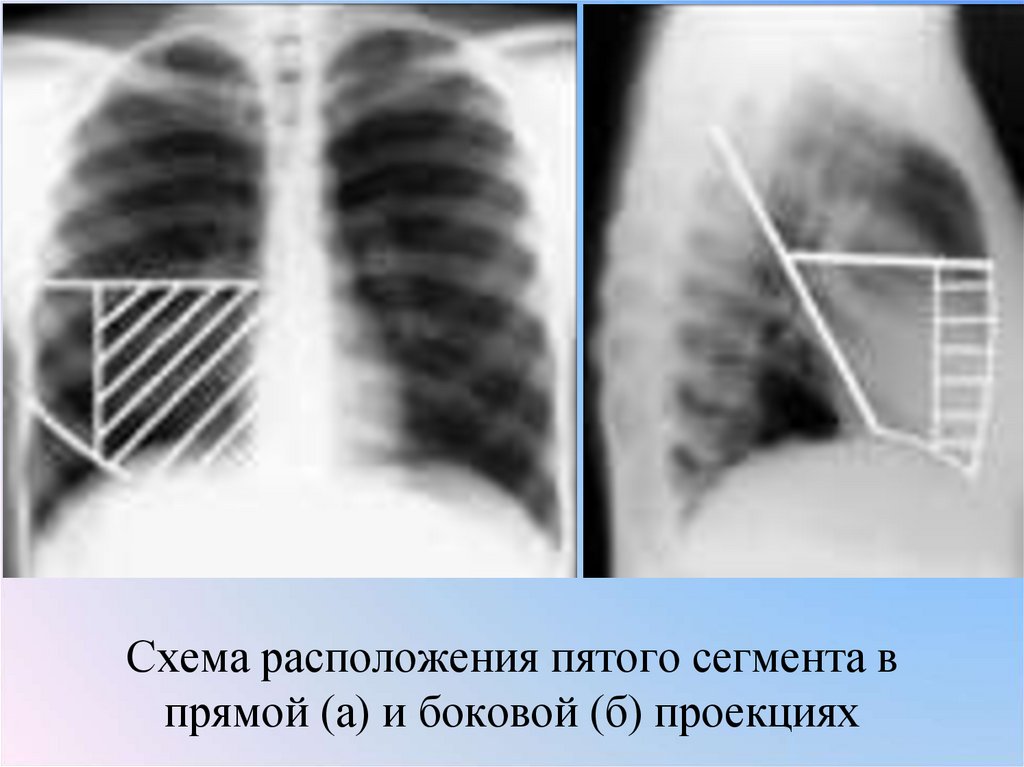 Схема расположения пятого сегмента в прямой (а) и боковой (б) проекциях
