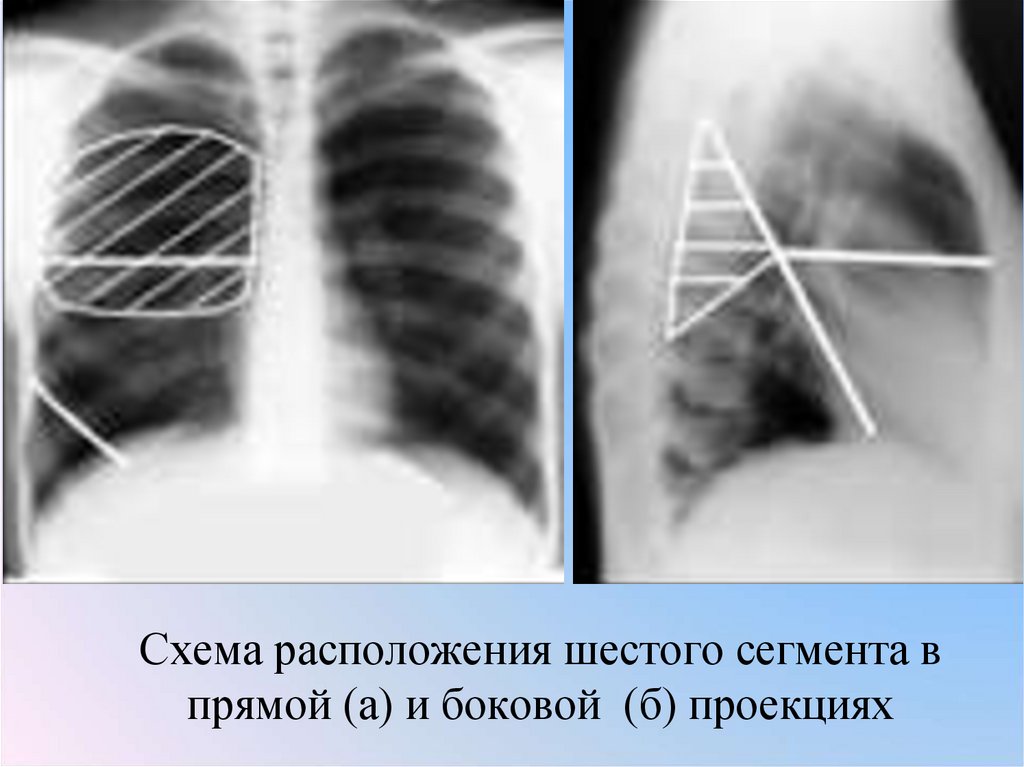 Схема расположения шестого сегмента в прямой (а) и боковой (б) проекциях