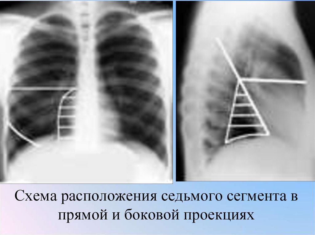 Схема расположения седьмого сегмента в прямой и боковой проекциях