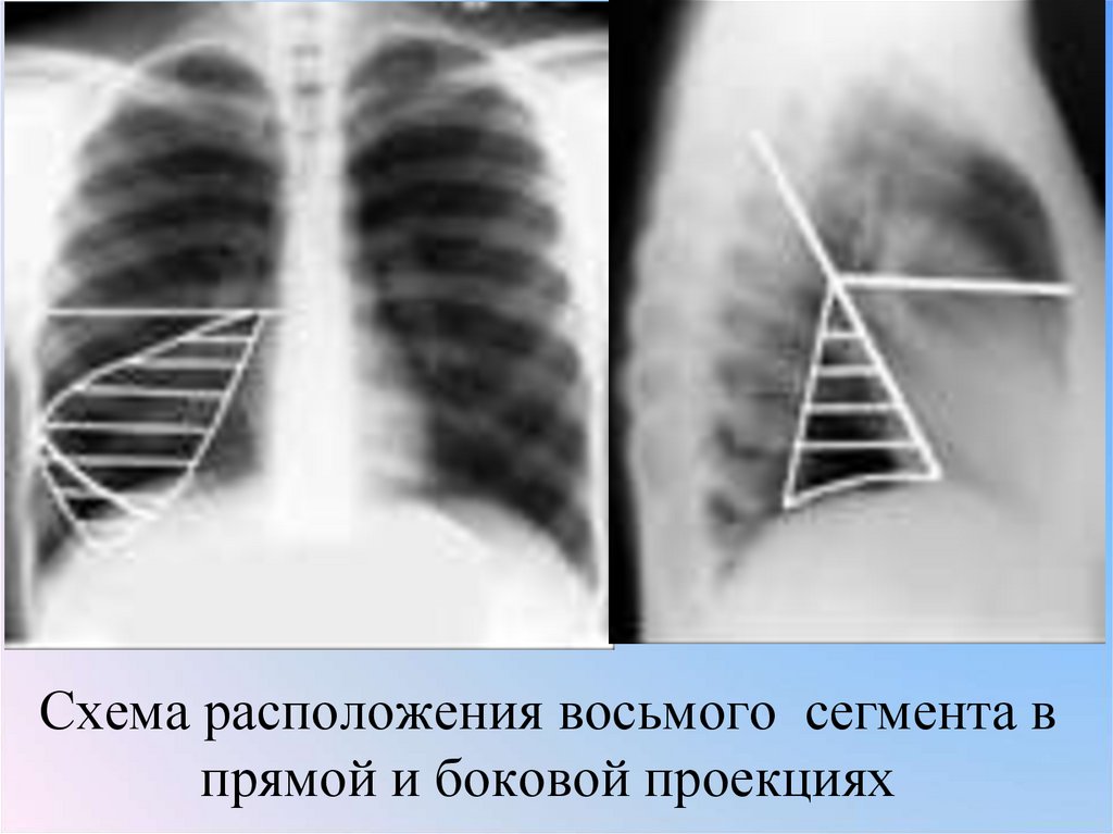 Схема расположения восьмого сегмента в прямой и боковой проекциях