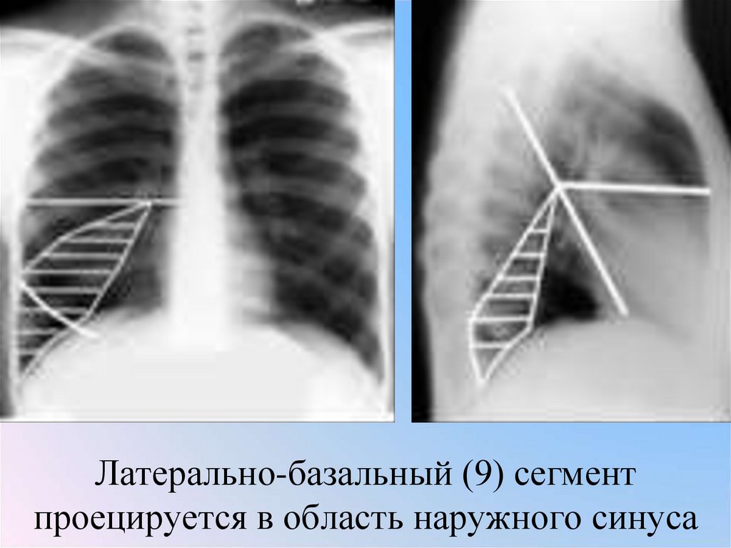 Латерально-базальный (9) сегмент проецируется в область наружного синуса