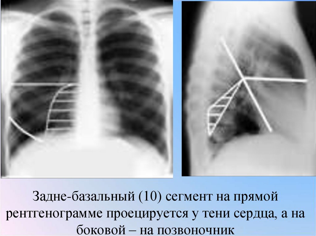 Задне-базальный (10) сегмент на прямой рентгенограмме проецируется у тени сердца, а на боковой – на позвоночник
