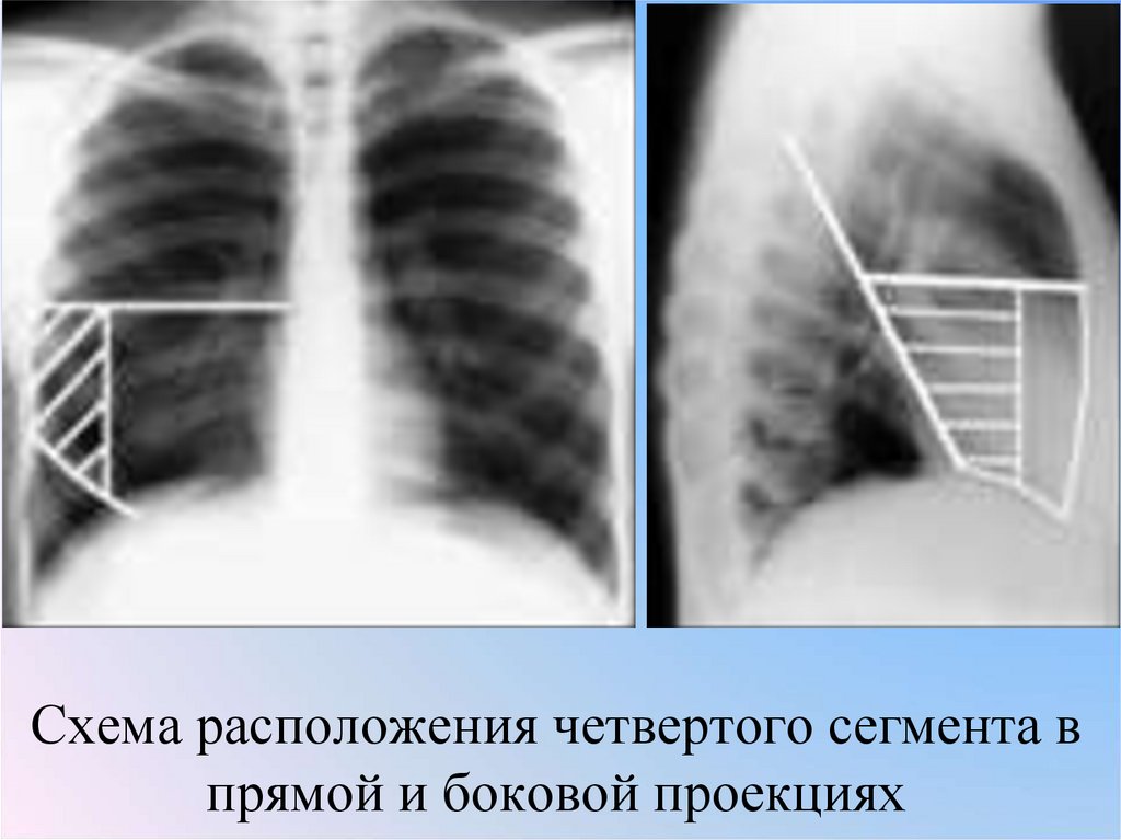 Схема расположения четвертого сегмента в прямой и боковой проекциях