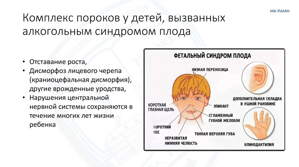 Комплекс пороков у детей, вызванных алкогольным синдромом плода