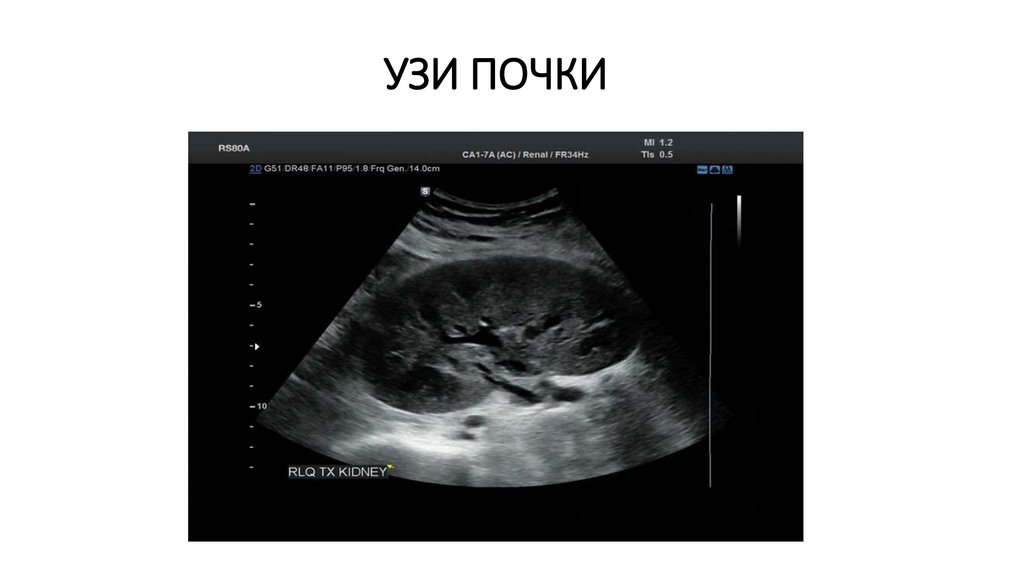 УЗИ ПОЧКИ