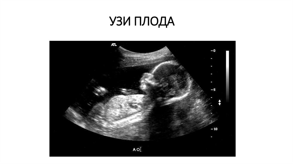УЗИ ПЛОДА