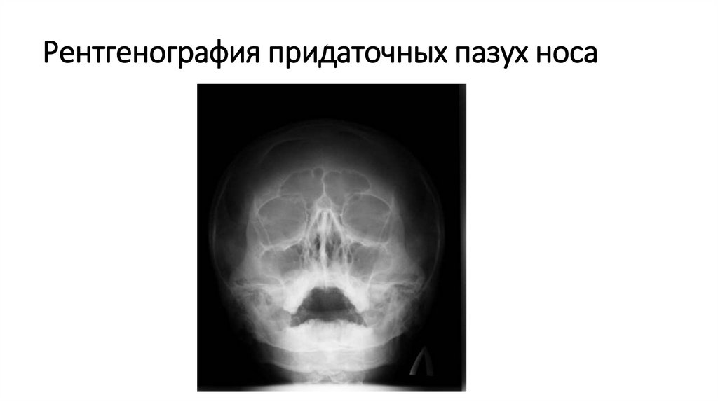 Рентгенография придаточных пазух носа