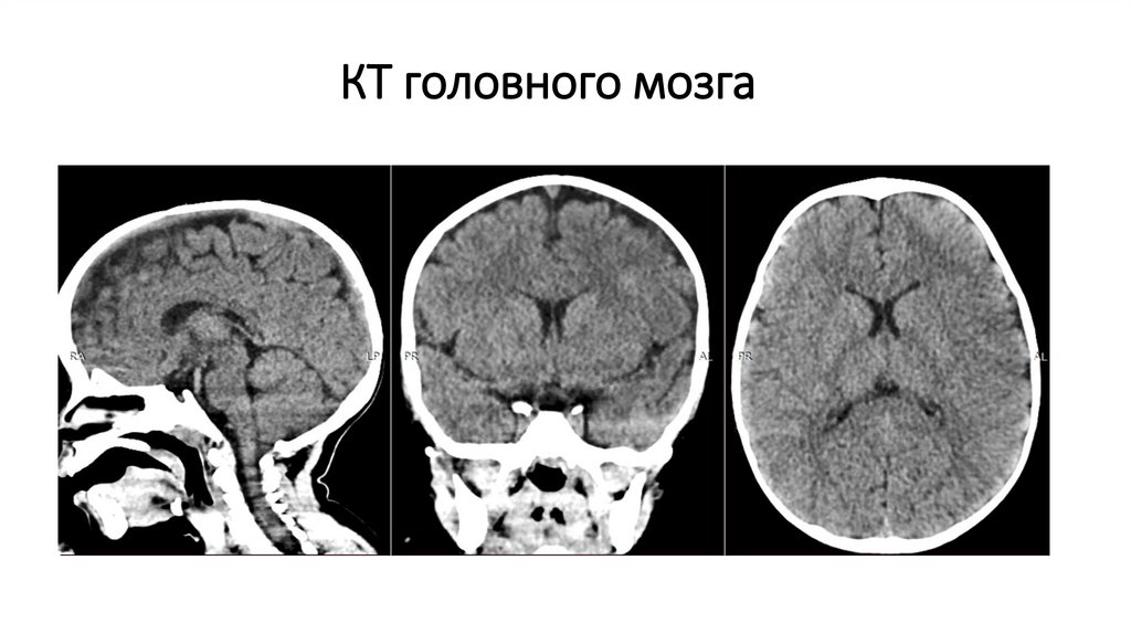 КТ головного мозга