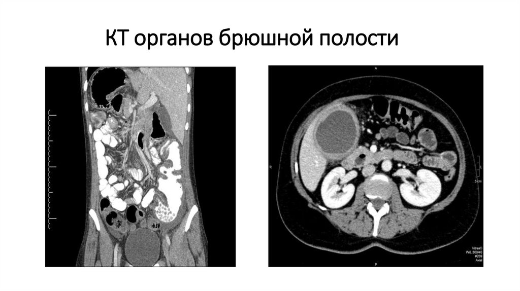 КТ органов брюшной полости
