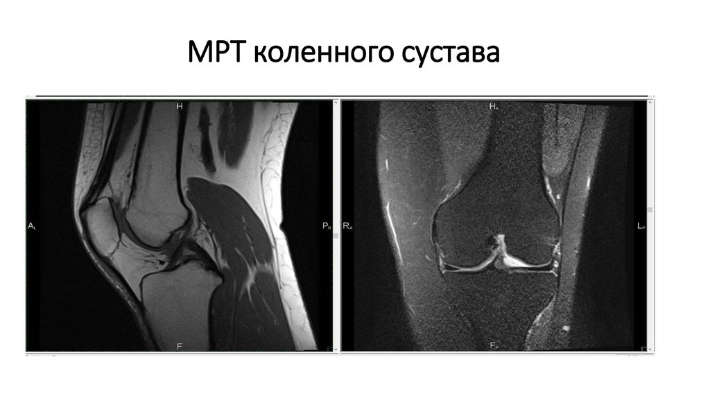 МРТ коленного сустава