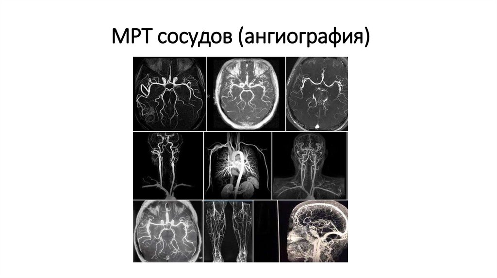 МРТ сосудов (ангиография)