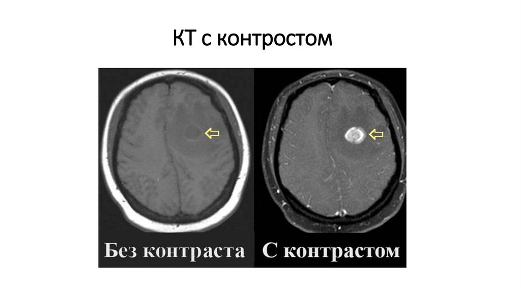 КТ с контростом