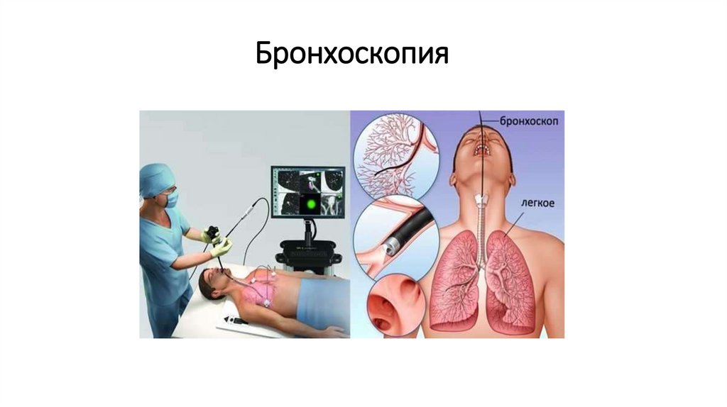 Бронхоскопия