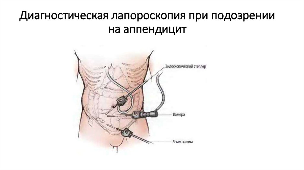 Диагностическая лапороскопия при подозрении на аппендицит