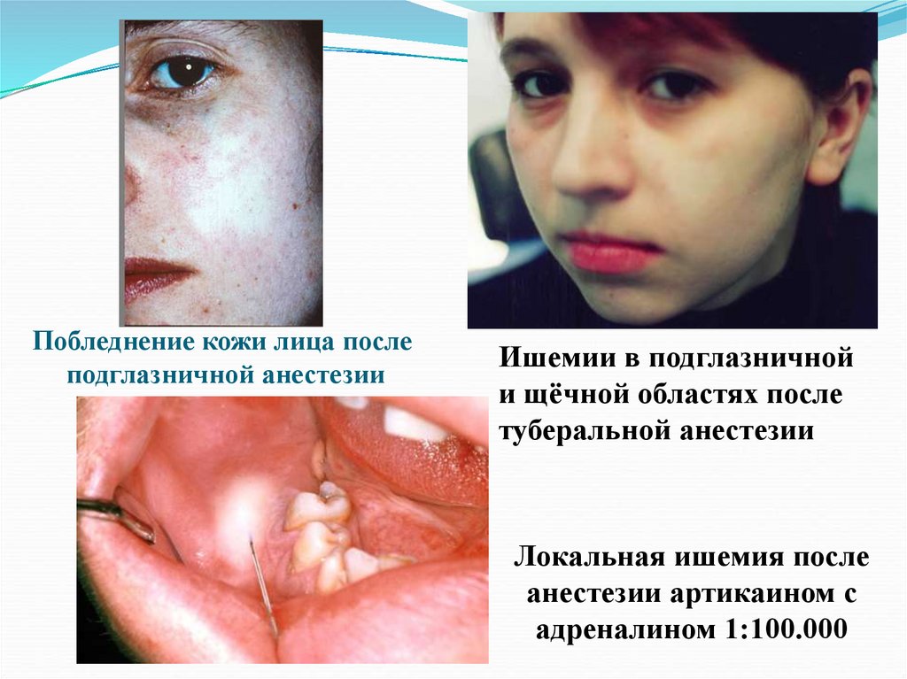 Побледнение кожи лица после подглазничной анестезии