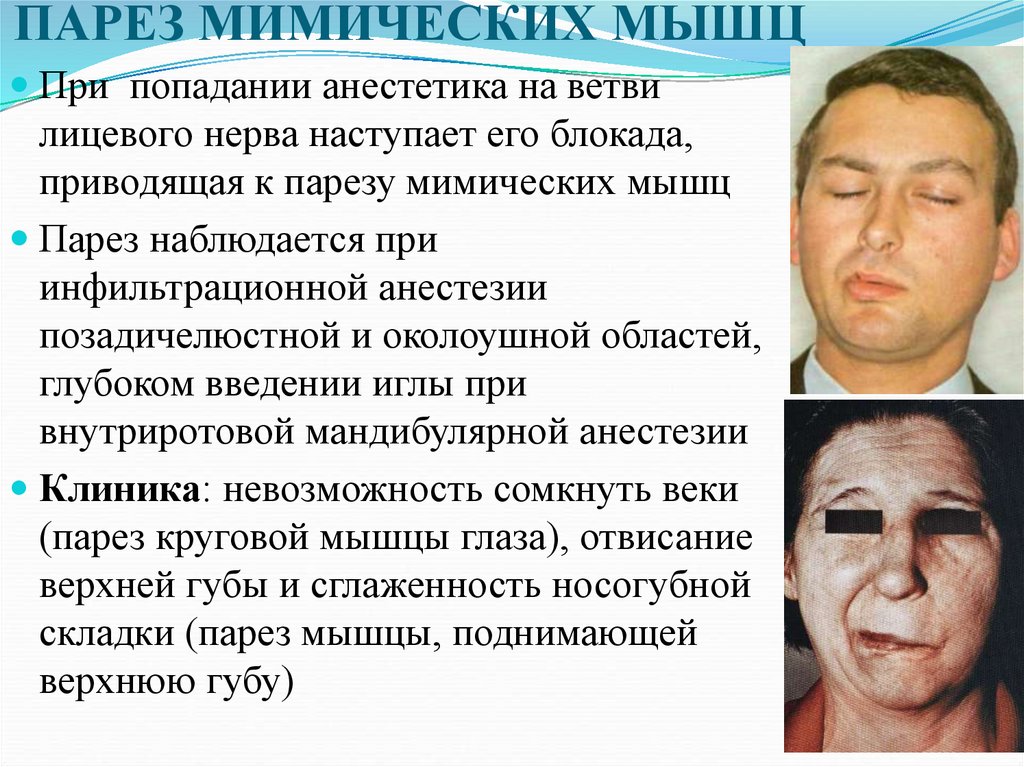 ПАРЕЗ МИМИЧЕСКИХ МЫШЦ