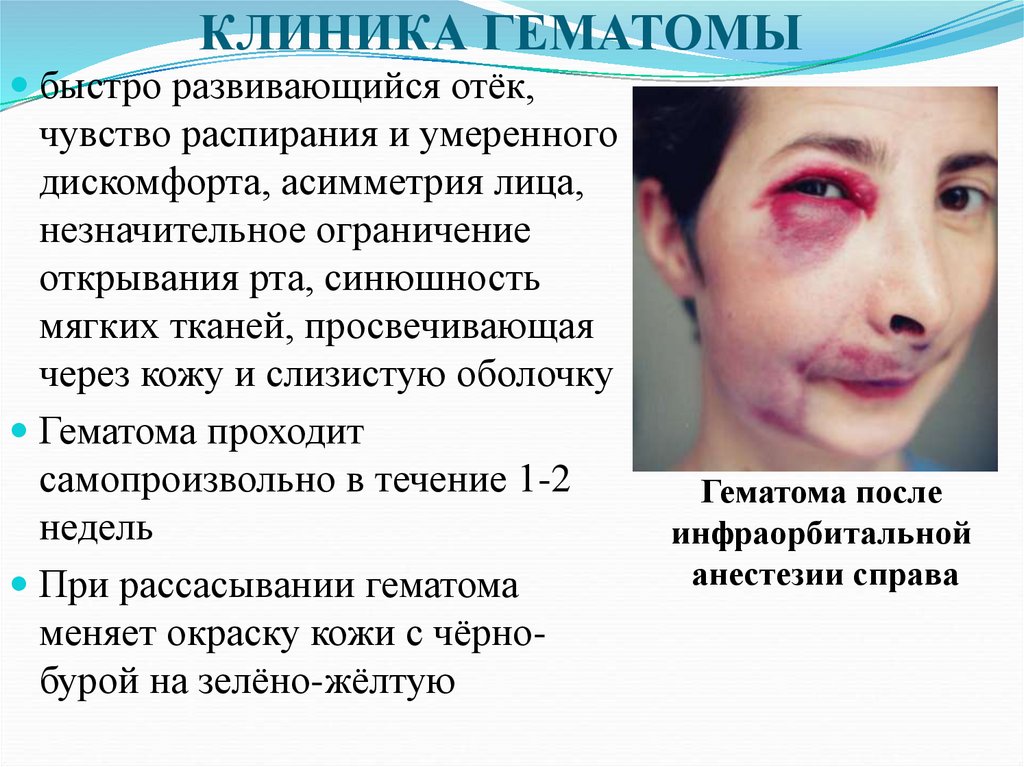 КЛИНИКА ГЕМАТОМЫ