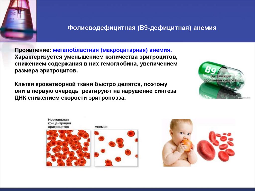 Фолиеводефицитная (В9-дефицитная) анемия