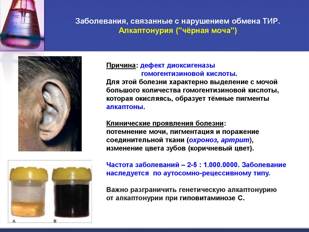 Заболевания, связанные с нарушением обмена ТИР. Алкаптонурия ("чёрная моча")