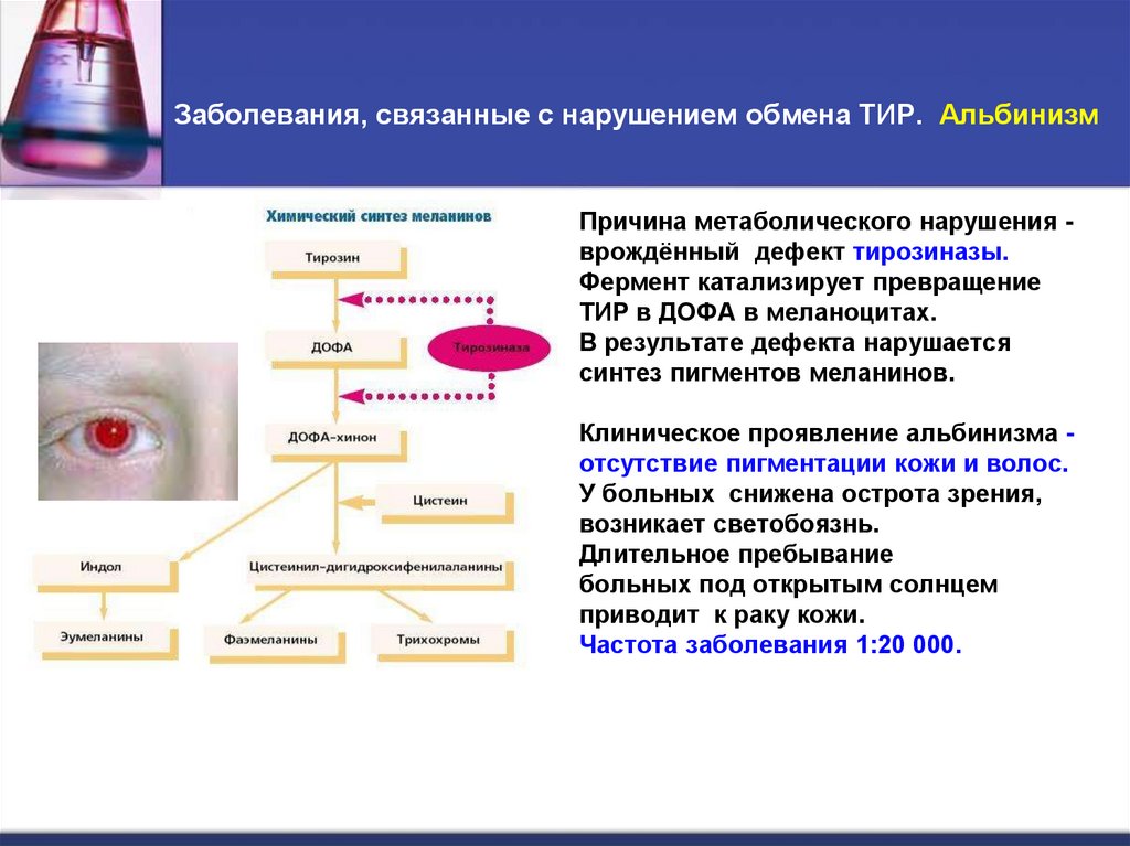 Заболевания, связанные с нарушением обмена ТИР. Альбинизм