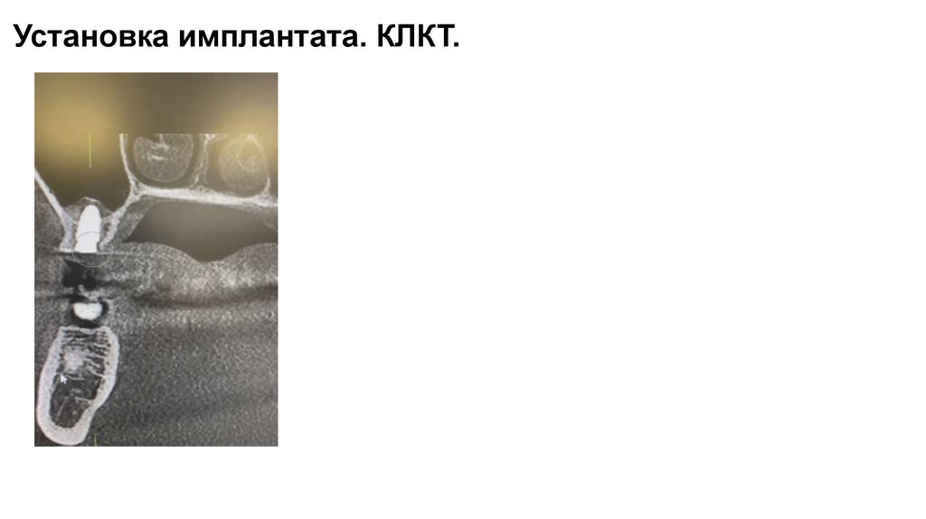 Установка имплантата. КЛКТ.