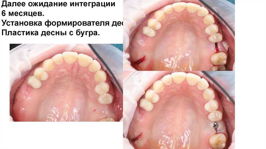 Далее ожидание интеграции 6 месяцев. Установка формирователя десны. Пластика десны с бугра.