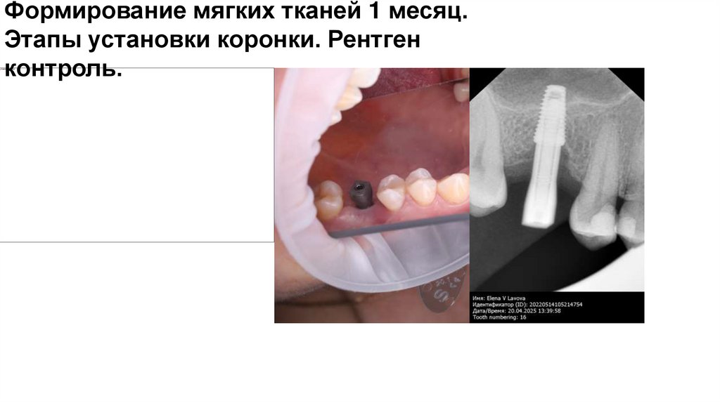 Формирование мягких тканей 1 месяц. Этапы установки коронки. Рентген контроль.