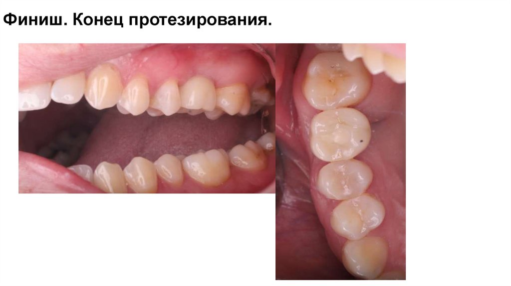 Финиш. Конец протезирования.