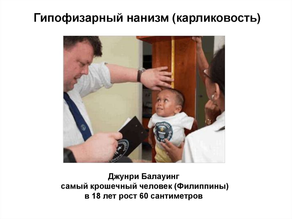 Гипофизарный нанизм (карликовость)