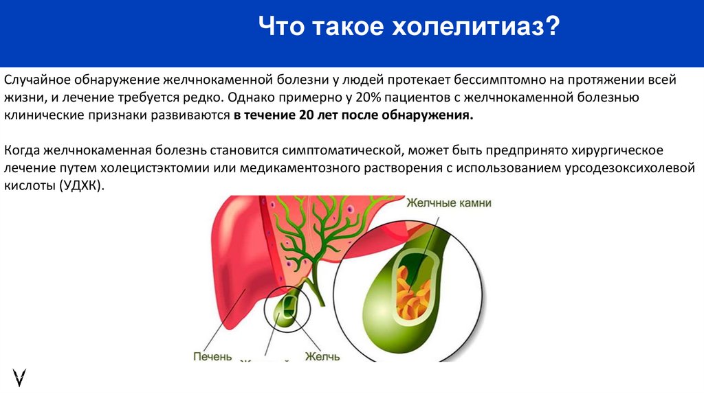 Что такое холелитиаз?