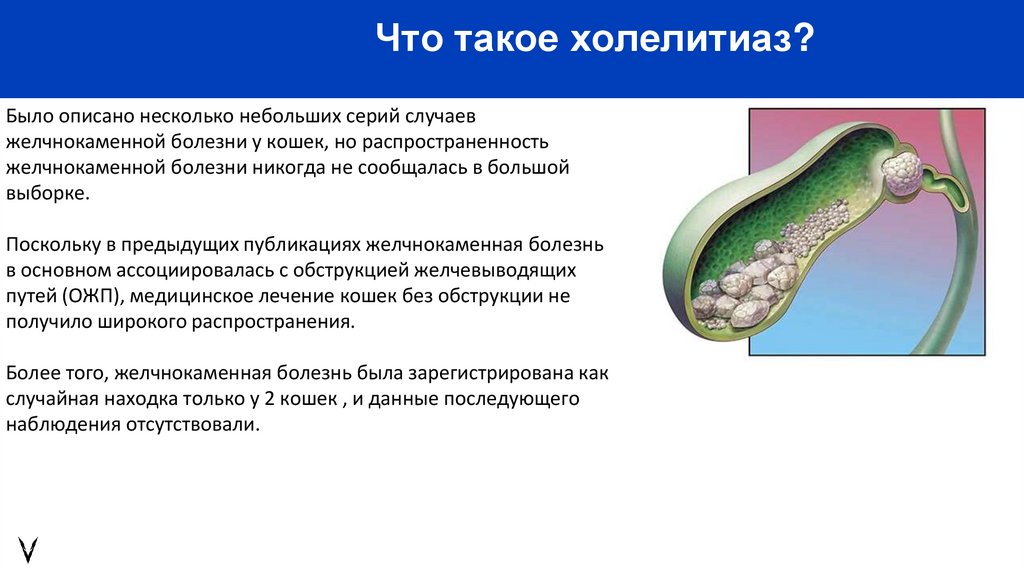 Что такое холелитиаз?