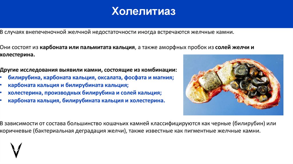 Холелитиаз