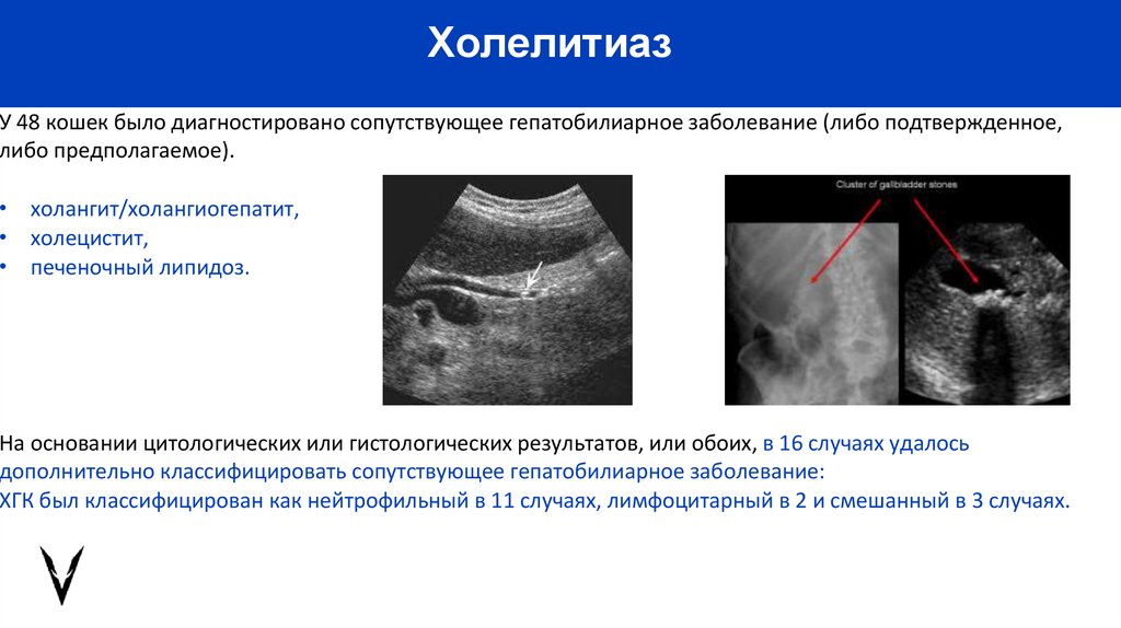 Холелитиаз