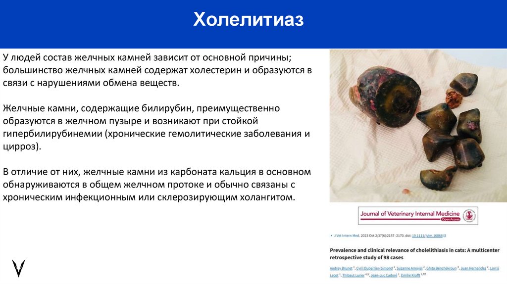 Холелитиаз