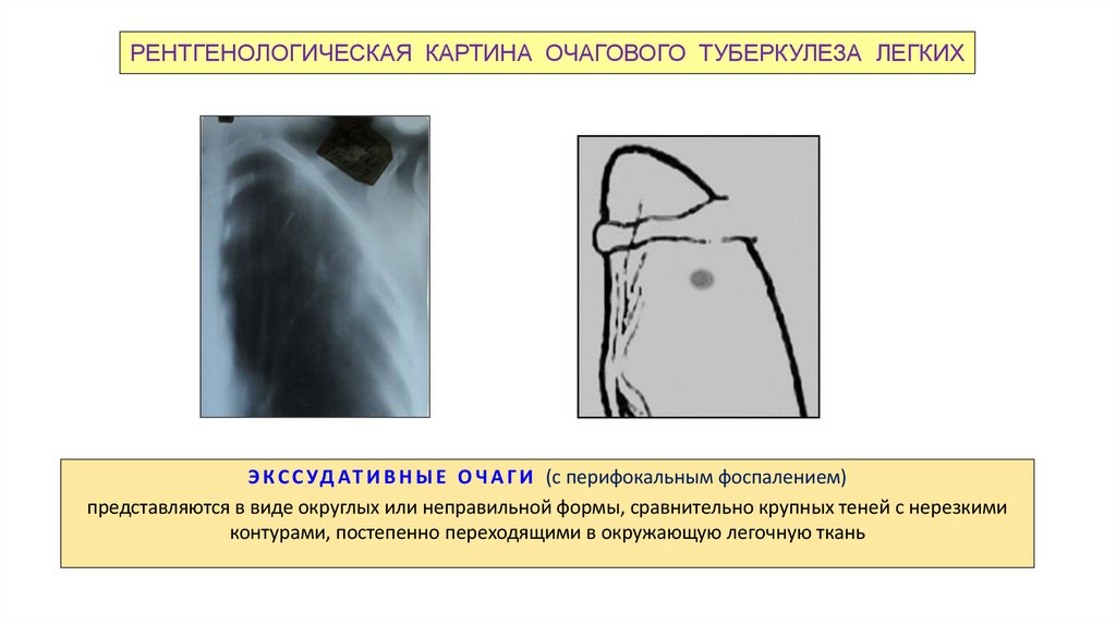 РЕНТГЕНОЛОГИЧЕСКАЯ КАРТИНА ОЧАГОВОГО ТУБЕРКУЛЕЗА ЛЕГКИХ