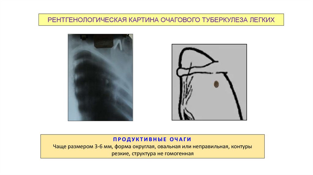 РЕНТГЕНОЛОГИЧЕСКАЯ КАРТИНА ОЧАГОВОГО ТУБЕРКУЛЕЗА ЛЕГКИХ