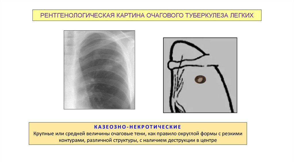 РЕНТГЕНОЛОГИЧЕСКАЯ КАРТИНА ОЧАГОВОГО ТУБЕРКУЛЕЗА ЛЕГКИХ