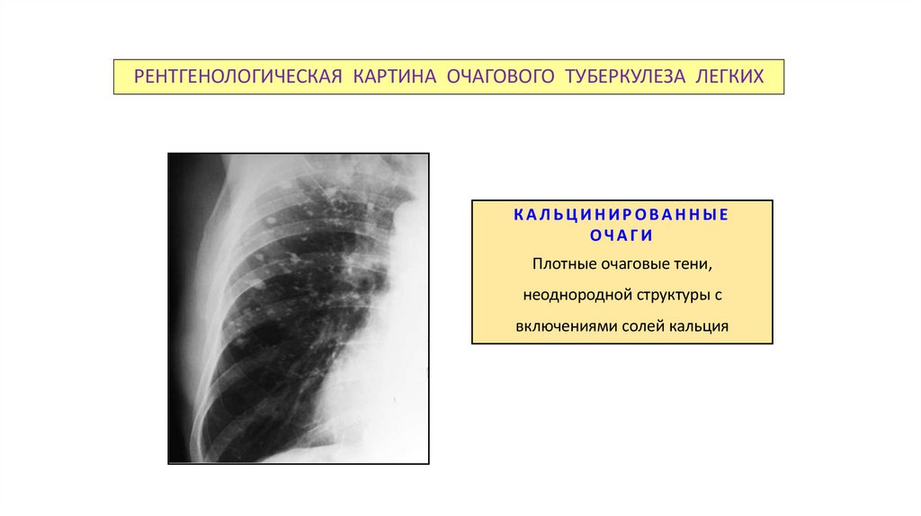РЕНТГЕНОЛОГИЧЕСКАЯ КАРТИНА ОЧАГОВОГО ТУБЕРКУЛЕЗА ЛЕГКИХ