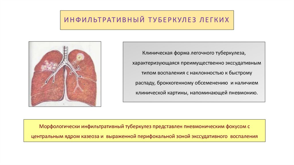 ИНФИЛЬТРАТИВНЫЙ ТУБЕРКУЛЕЗ ЛЕГКИХ