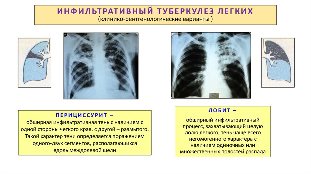 ИНФИЛЬТРАТИВНЫЙ ТУБЕРКУЛЕЗ ЛЕГКИХ (клинико-рентгенологические варианты )