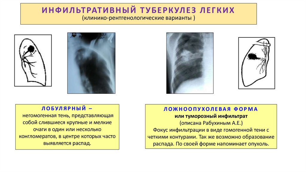 ИНФИЛЬТРАТИВНЫЙ ТУБЕРКУЛЕЗ ЛЕГКИХ (клинико-рентгенологические варианты )