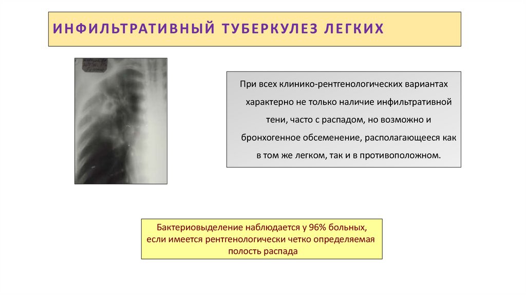 ИНФИЛЬТРАТИВНЫЙ ТУБЕРКУЛЕЗ ЛЕГКИХ